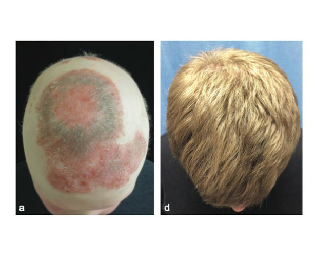 Scientists At Yale Have Cured Baldness